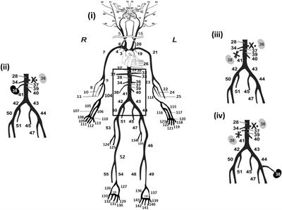 Assessment of Stiffness of Large to Small Arteries in Multistage Renal Disease Model: A Numerical Study